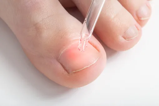nail fungus laser treatment