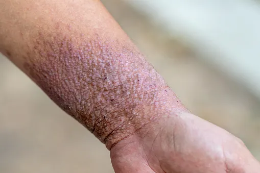 what is the difference between eczema and psoriasis