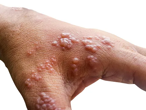 early stage shingles rash